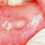Fibroepithelial Polyp